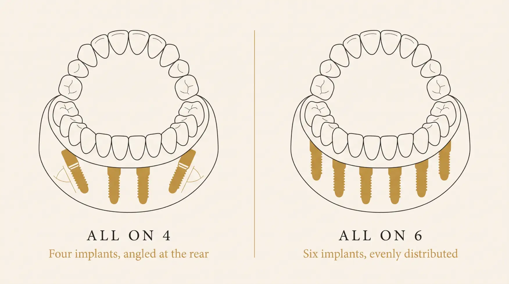 Full arch restoration result using All on 4 or All on 6 implants