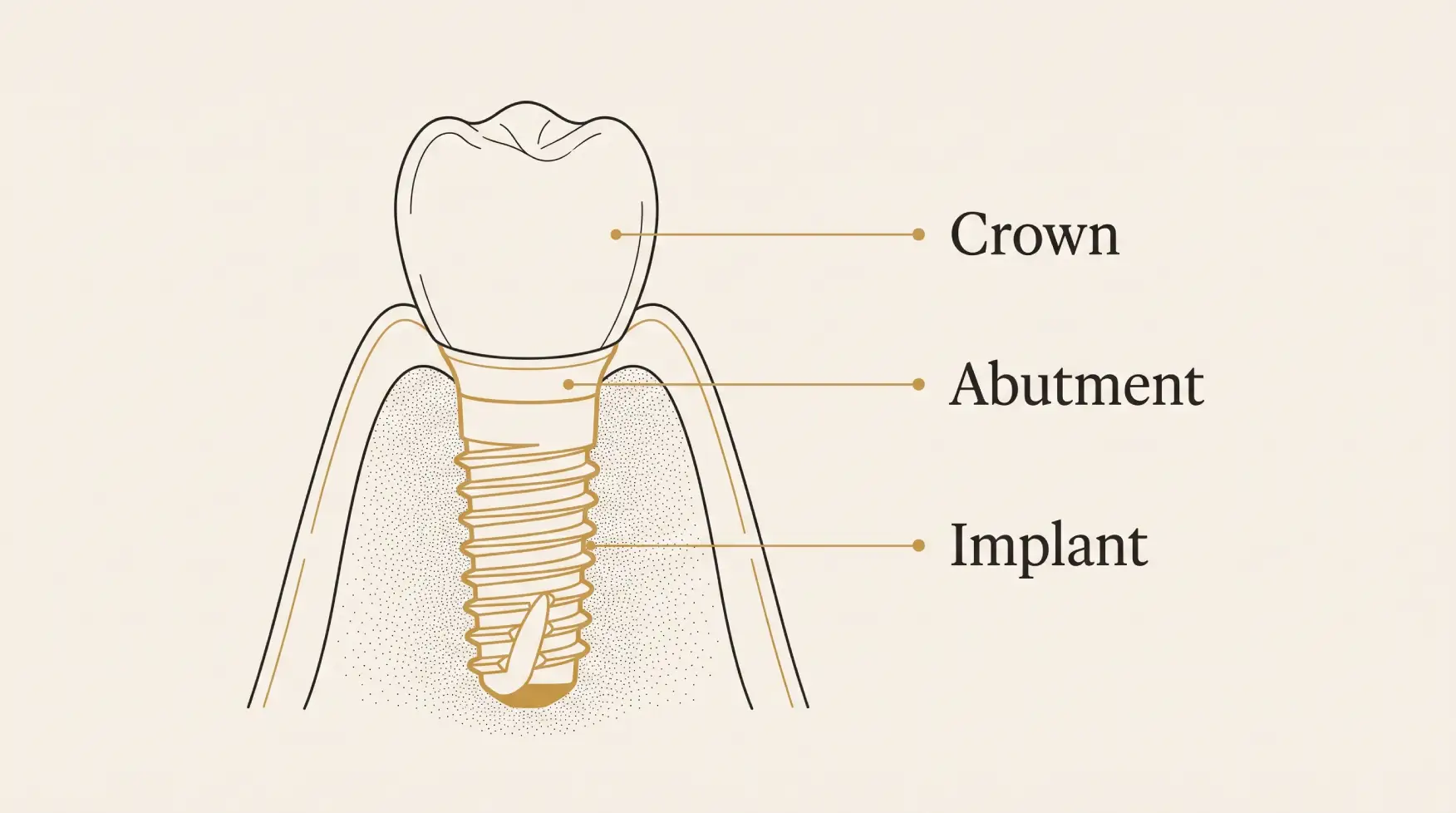 Daily oral hygiene helps dental implants last longer