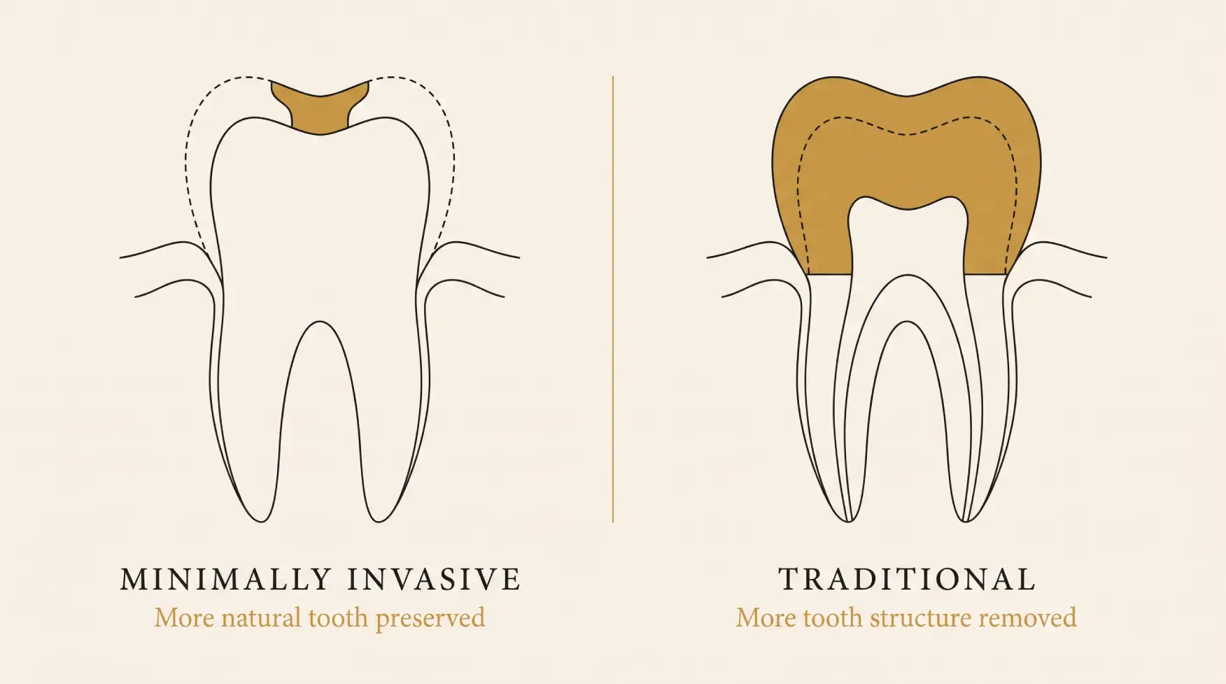 Illustration comparing minimally invasive and traditional dental treatment