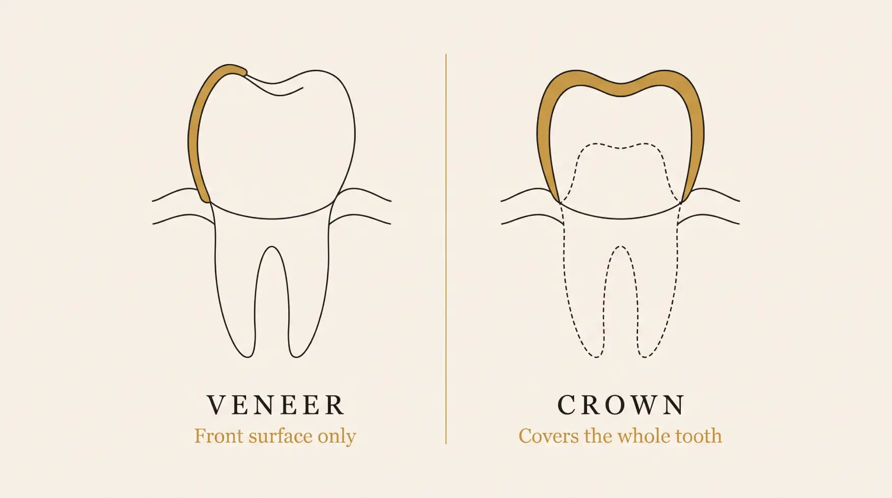Diagram comparing how much natural tooth a porcelain veneer and a zirconia crown each cover