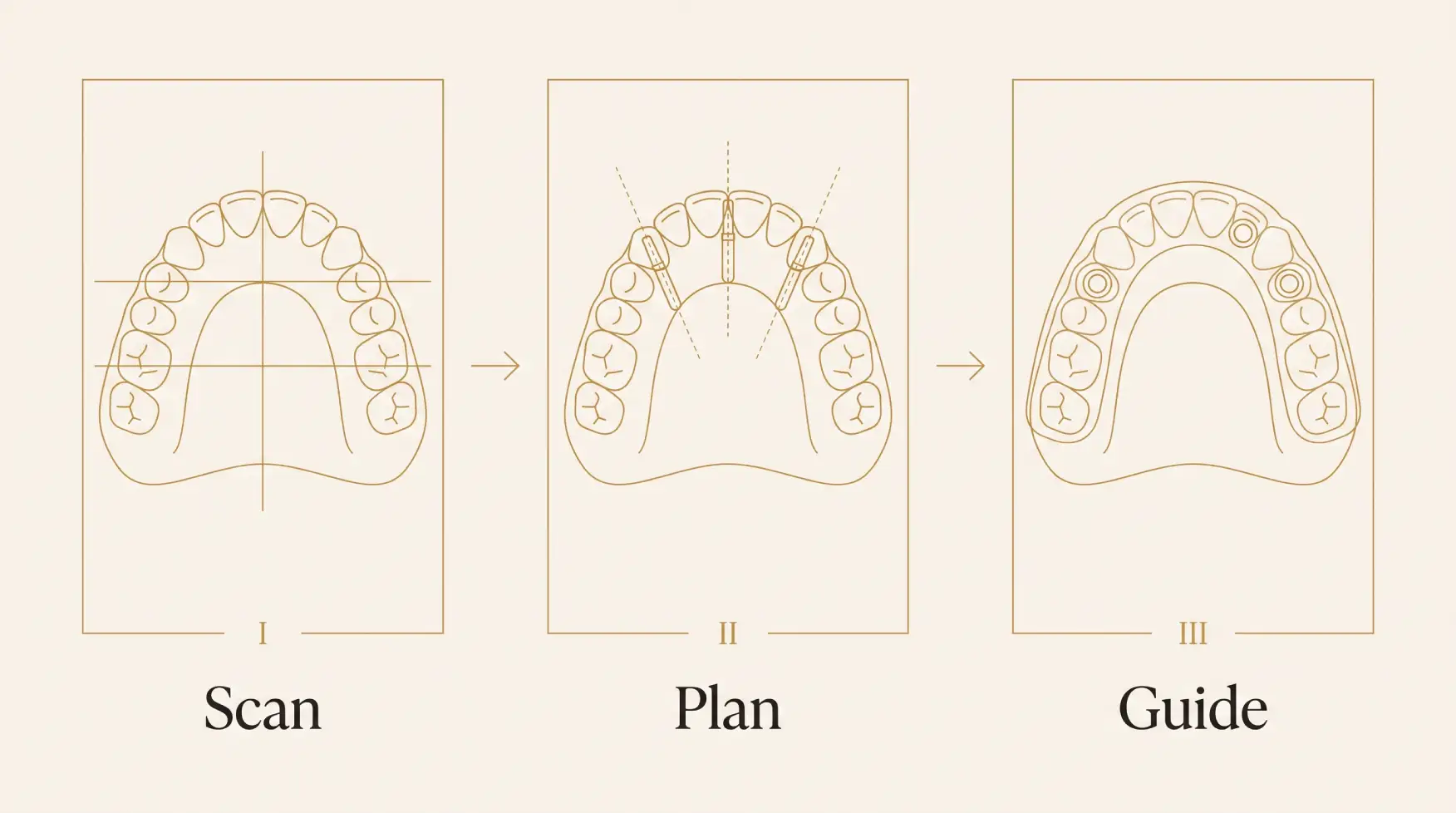 Diagram of the guided implant surgery process, from 3D scan to surgical guide to placement