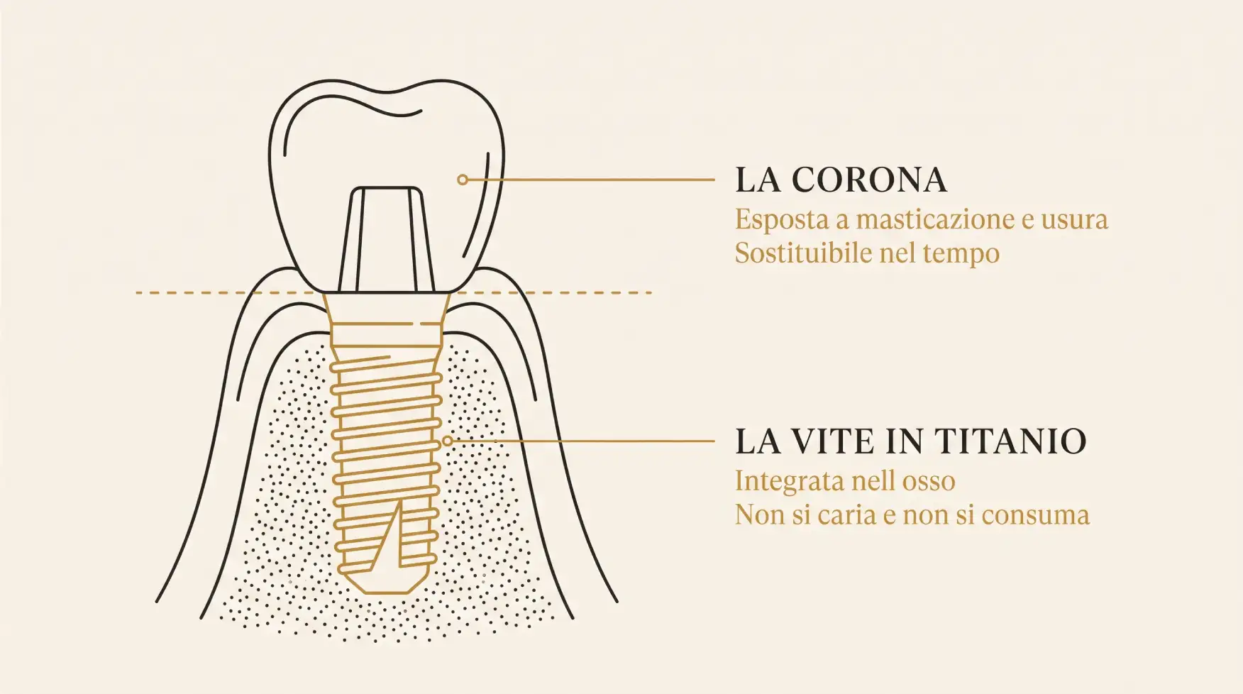 Le due componenti di un impianto dentale e la loro diversa durata nel tempo