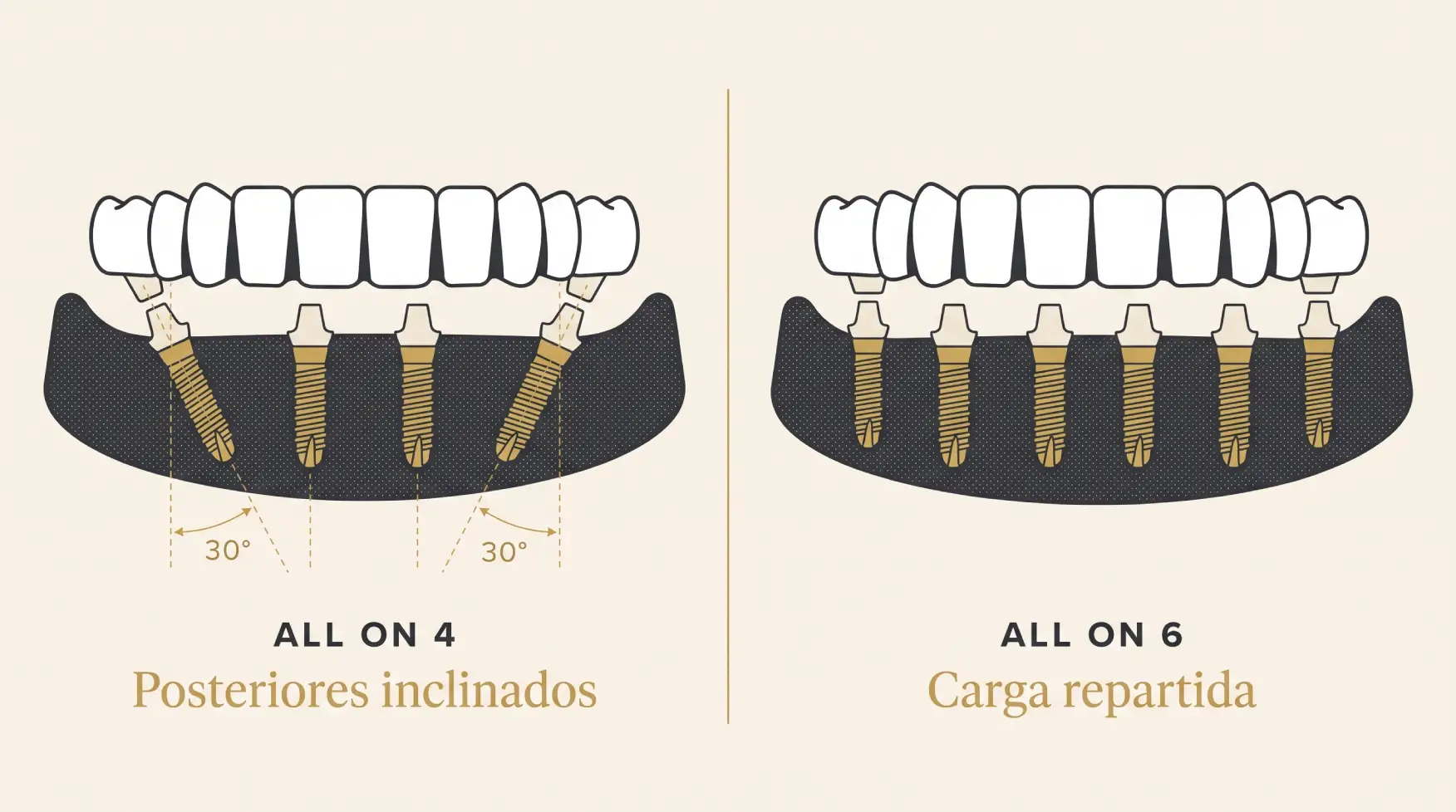 All on 4 o All on 6 en Albania: cuál elegir para un reemplazo total de dientes