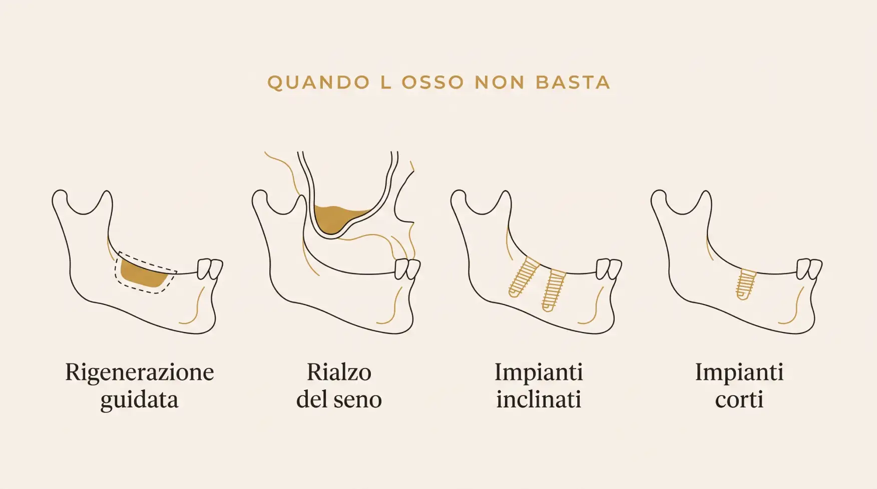 Le quattro soluzioni quando l'osso non è sufficiente per gli impianti dentali