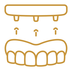 Full Arch Implant Rehabilitation Albania - All on 4 and All on 6 Dental Implants